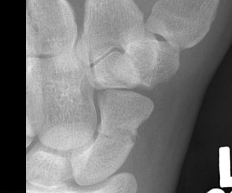 Scaphoid Fracture Long Axis